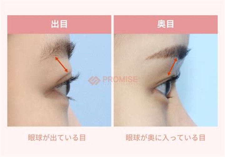 出目と奥目の違い比較